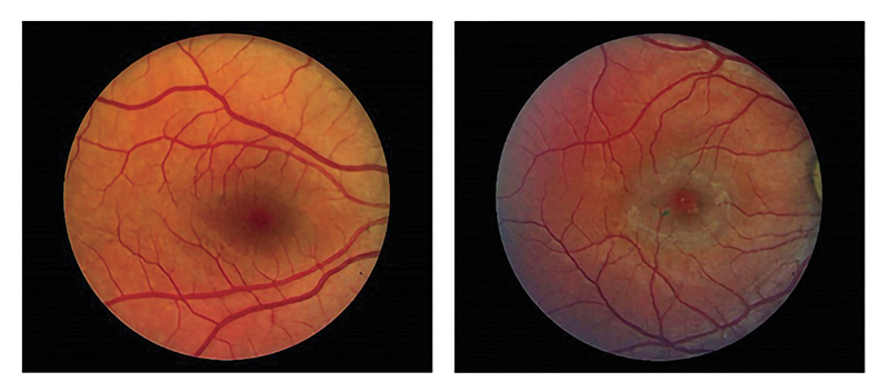 Left: Image of a healthy retina. Right: Image of a retina affected by macular telangiectasia type 2.